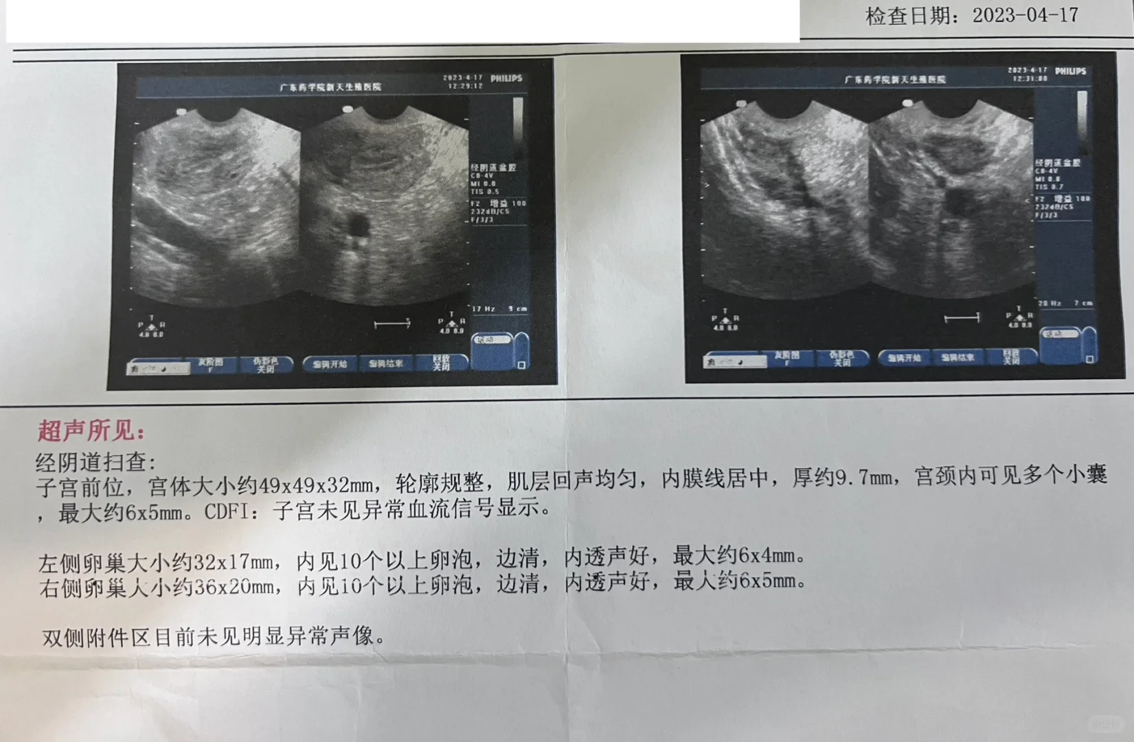 没有看到优势卵泡不一定没有排卵,高成功率代孕，代孕机构官网网站
